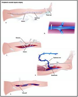 Peripheral Bypass Surgery, Peripheral Bypass India