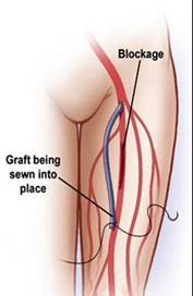 Peripheral Bypass Surgery, Peripheral Bypass India, Peripheral Vascular  Bypass Surgery