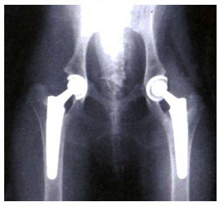 Simultaneous Bilateral Hip Replacement surgery, Simultaneous Bilateral Hip Replacement surgery India