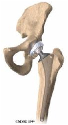 Ceramic Hip Replacement, Ceramic Hip Replacement India, Ceramic Hip Replacement Information, Ceramic