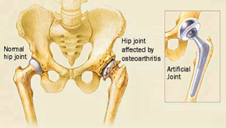 Hip Replacement Abroad, Hip Replacement Surgery