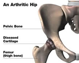 Hip Pain Causes, Hip Pain Diagnosis, Hip Pain  Injuries, Hip Pain Information, Diagnosis