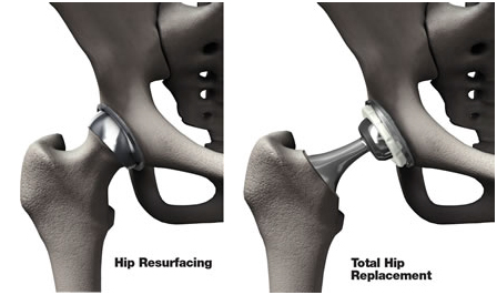 Hip Pain Treatment, Hip Pain Diagnosis, Hip Pain  Injuries, Diagnosis, Resources