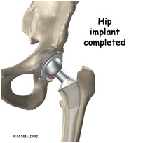 Hip Replacement Implant India, Hip Replacement, Hip, Hip Implants