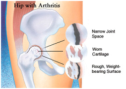 Total Hip Replacement Surgery, THR, Hip Replacement Surgery, Operation