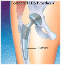 Hip Surgery India, Total Hip Replacement, THR, Exercises