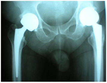 Birmingham Hip Replacement India, Hip Resurfacing, Hip Resurfacing India