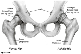 Birmingham Hip Resurfacing India, Hip Resurfacing abroad, Birmingham Hip Replacement