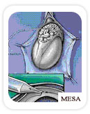MESA Treatment, India Mesa Treatment, India Advantages Of Mesa