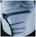 High Tibial Osteotomy Surgery, Hemicallotasis, Closing Wedge Osteotomy