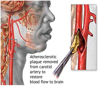 Carotid Artery Surgery India, Carotid Endarterectomy Surgery India, Carotid artery disease India
