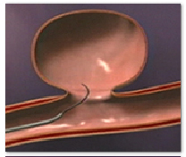 Endovascular Coiling Surgery India Offers info on Endovascular India, Coiling India