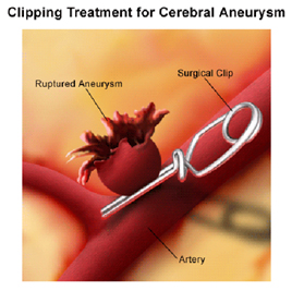 Surgical Clipping Surgery India Offers info on Clipping India, Surgical Clipping India, Surgical Clipping Surgery India