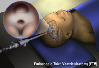 Ventriculostomy India, Ventriculostomy Surgical Procedure India, Third Ventriculostomy India