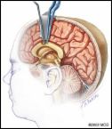 Corpus Callosotomy Surgery India Offers info on Corpus Callosotomy India, Callosotomy India, Corpus Colostomy India