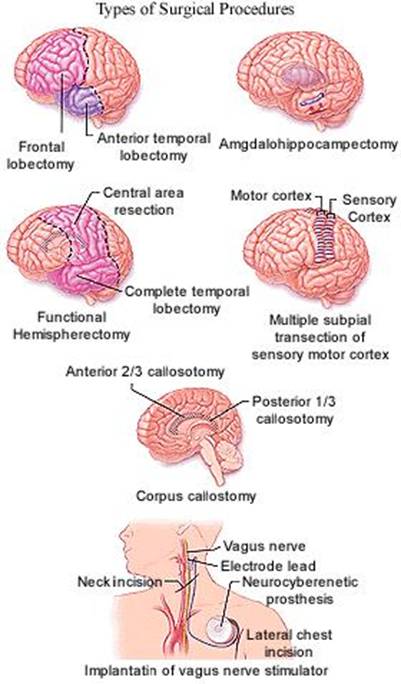 Epilepsy Treatment India Offers info on Epilepsy India, Epileptic Seizures India, Epilepsy Treatment India, Epilepsy Research India, Seizure Medicines India, Treating Epilepsy India