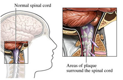 Multiple Sclerosis surgery Types India, Multiple Sclerosis Delhi Hospitals India, Mumbai Price India, Brain Surgery Delhi Hospital, Multiple Sclerosis Procedure, Ms Treatment Delhi India, Multiple Sclerosis surgery Causes, Pregnancy Problems Childbirth, Multiple Sclerosis Surgery, affordable Multiple Sclerosis surgery, Sclerosis, Multiple Sclerosis Delhi Surgeon India, Brain & Spine Surgery,  Multiple Sclerosis Surgery Symptoms, Multiple Sclerosis Delhi Center India, Multiple Sclerosis Treatment, Low Cost Multiple Sclerosis Treatment