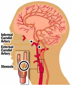 Stroke India Offers info on Stroke Treatment India, Stroke Rehabilitation India, Stroke Treatment Center India