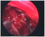 Endoscopic Microdiscectomy, Endoscopic, India Micro Disectomy, Endoscopic
