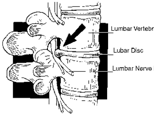Percutaneous Endoscopic Lumbar Discectomy