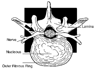 Endoscopic, Percutaneous Endoscopic, Arthroscopic, Thoracic Discectomy, Percutaneous