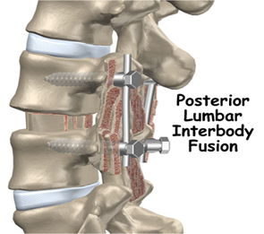 Posterior Lumbar Interbody Fusion Surgery, Surgery