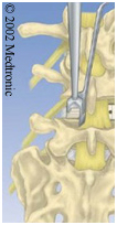 Posterior Lumbar Interbody Fusion Surgery, Surgery, Interbody Fusion Surgery, Lumbar