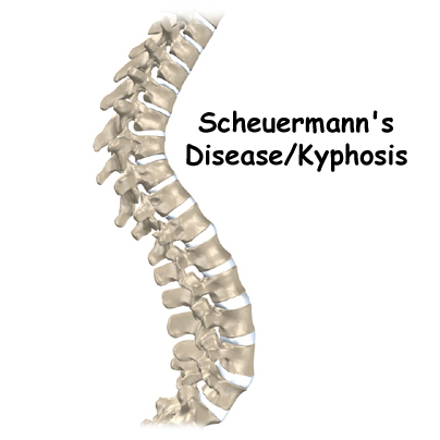 Scheuermann's Disease, Sherman's Disease, Scheuermann's Kyphosis