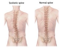 Scoliosis Treatment, Scoliosis Surgery India, Scoliosis Surgery, Back Braces