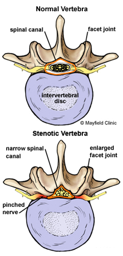 Decompressive Laminectomy, Spinal Stenosis, Decompressive