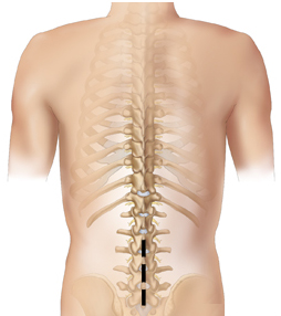 Spinal Stenosis, Decompressive, Decompressive Laminectomy For, Spinal Stenosis, Laminectomy
