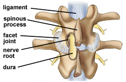 Spinal Stenosis, Decompressive Laminectomy For, Laminectomy