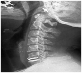 Disc Replacement Surgery India, Degenerative Disc Disease, Spine Health, Artificial Disc Replacement