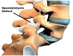 Spondylosis Surgery, Spondylosis,  Surgery For Cervical Spondylosis, Spondylosis Treatment India, Treatment Of Spondylosis