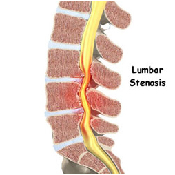 Lumbar Canal Stenosis Surgery, India Lumbar Spinal Canal Stenosis