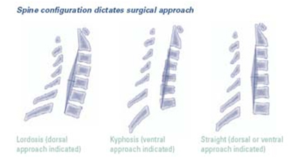 Cervical Spondylotic Myelopathy, Arthritis And Cervical Spondylosis, Cervical Spondylosis India