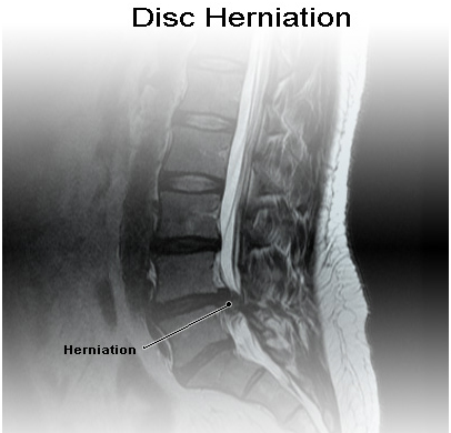 Slipped Disc, Slipped disc surgery India