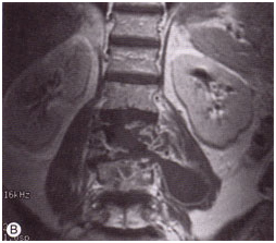 Spinal Tuberculosis Treatment, Isoniazid, Rifampicin, Pyrazinamide, And Ethambutol