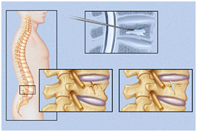 Vertebroplasty Surgery, Vertebroplasty India, Vertebrae, Vertebra Therapy