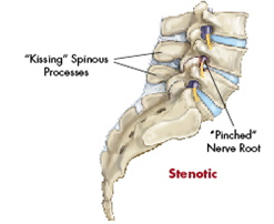 X Stop Spine Surgery Procedure