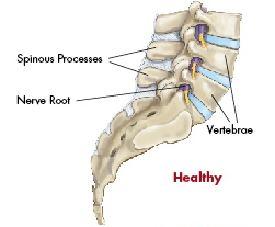 X Stop Spine Surgery,X Stop Spinal Stenosis Surgery India,X Stop India