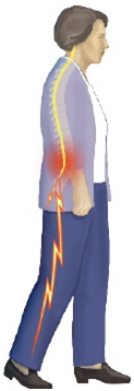 X Stop Spine Surgery,X Stop Spinal Stenosis Surgery India,X Stop India