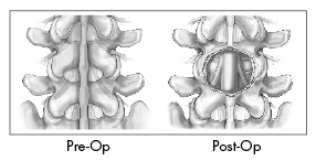 X Stop Spine Surgery,X Stop Spinal Stenosis Surgery India,X Stop India