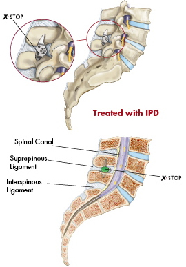 X Stop Spine Surgery,X Stop Spinal Stenosis Surgery India,X Stop India