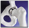 Bangalore hospital, low cost surgery Bangalore,  knee replacement