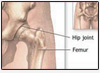 low cost surgery Bangalore, hip replacement, hip resurfacing,  knee replacement