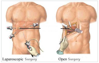 Minimal Access Invasive Surgery Wockhardt Hospital Mumbai, Laparoscopic-Appendectomy