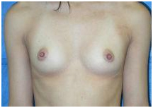 Breast Augmentation Surgery India