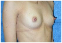 Breast Augmentation Surgery India, Breast Augmentation Surgery India, Breast Implant India, Breast Enlargement