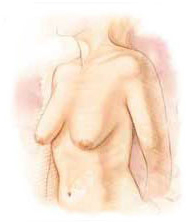 Breast Lift India, Breast, Breast Lift Surgery Photos